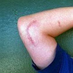Tommy John